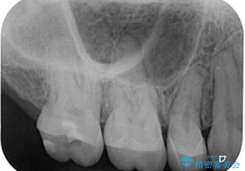 目立つ銀歯を白くしたい 奥歯のセラミック治療の治療後