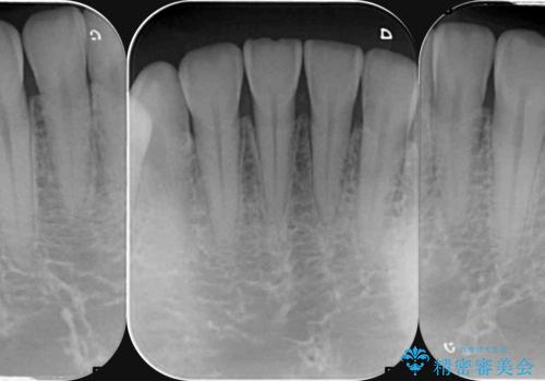 歯ぎしりですり減った 前歯の見た目を回復したいの治療前