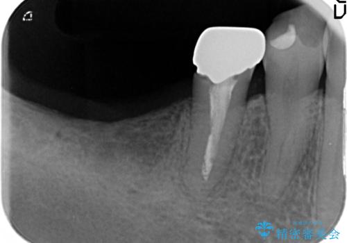 インプラント治療による咬合機能回復の治療前