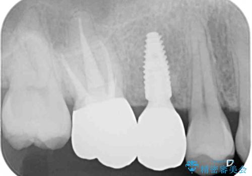 インビザラインによる矯正治療と、折れてしまった歯のインプラント補綴治療の治療後