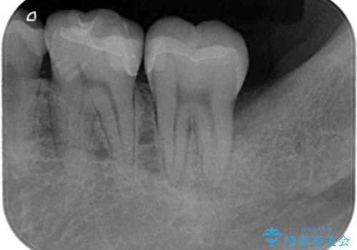 目立つ銀歯を自然にしたいの治療後