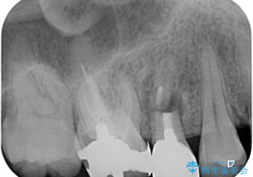 インビザラインによる矯正治療と、折れてしまった歯のインプラント補綴治療の治療前