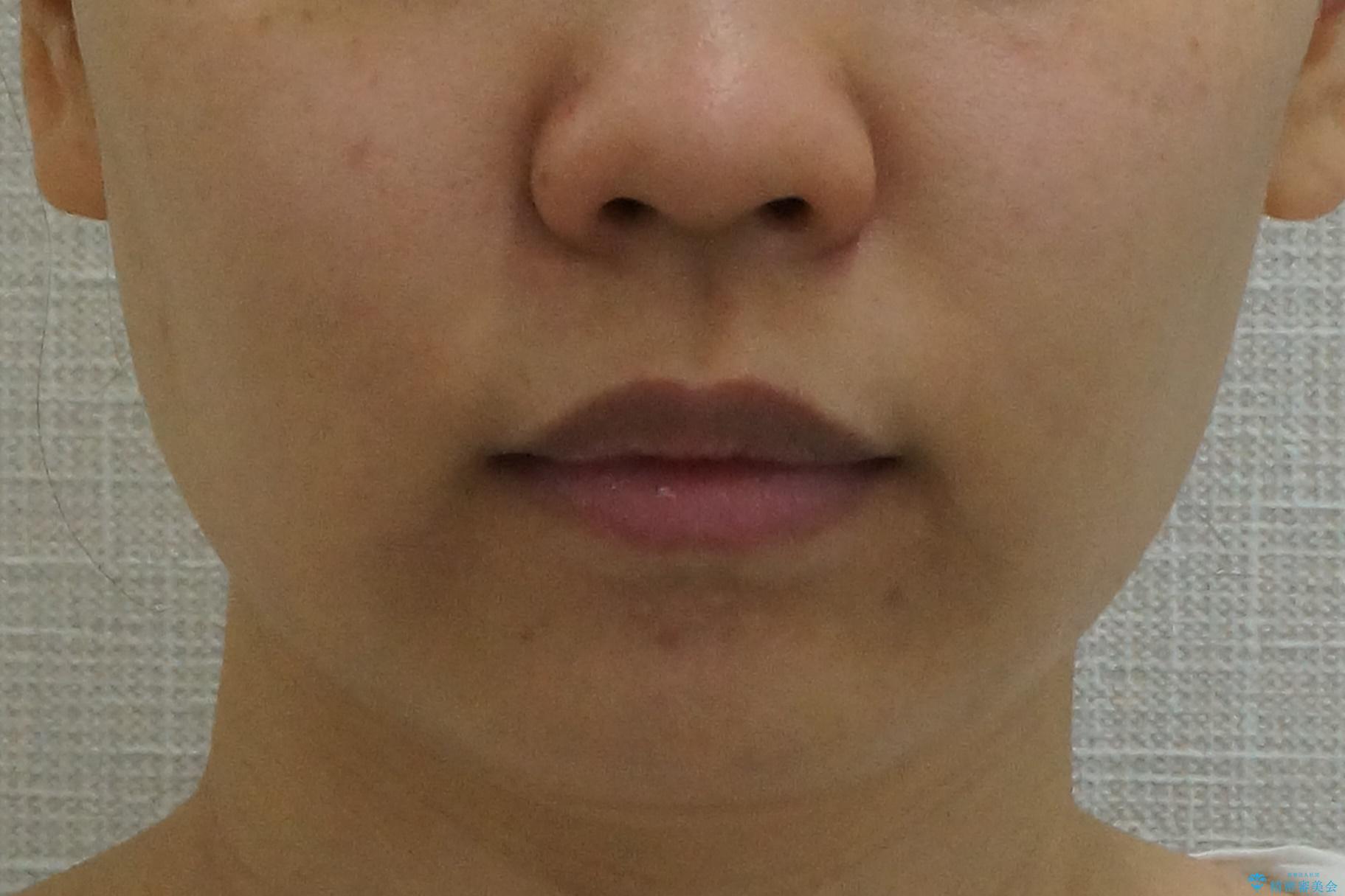 深いかみ合わせ 出っ歯の治療 インビザラインでの治療後(顔貌)