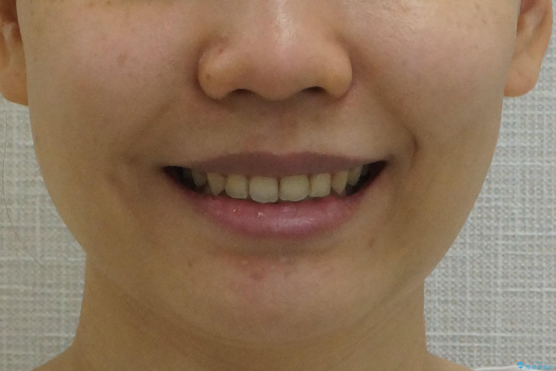 深いかみ合わせ 出っ歯の治療 インビザラインでの治療後(顔貌)