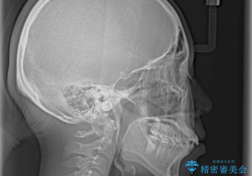前歯の出っ歯と口の閉じにくさを抜歯矯正で改善 目立たないワイヤー矯正の治療前