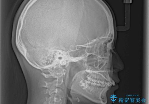 下の前歯が隠れてしまうほど深い咬み合わせ 高校生のインビザライン矯正治療の治療前