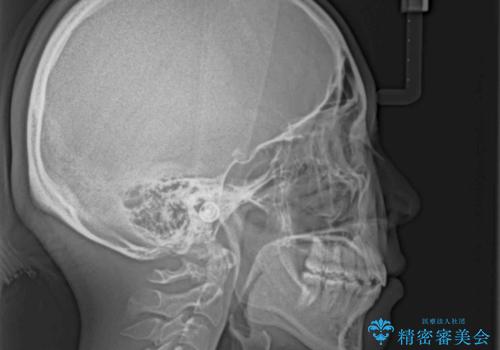 前歯の出っ歯と口の閉じにくさを抜歯矯正で改善 目立たないワイヤー矯正の治療後