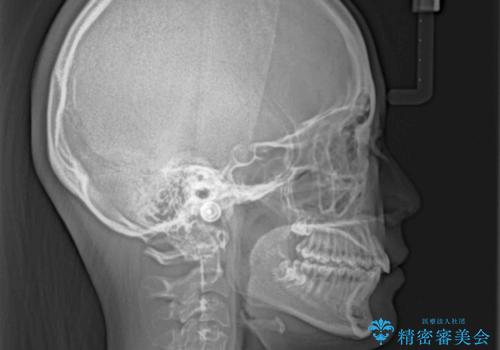 下の前歯が隠れてしまうほど深い咬み合わせ 高校生のインビザライン矯正治療の治療後