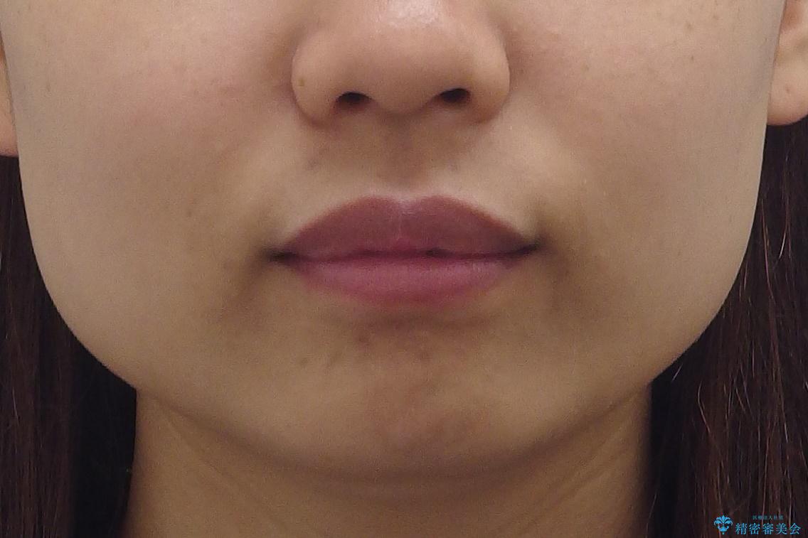 深いかみ合わせ 出っ歯の治療 インビザラインでの治療前(顔貌)