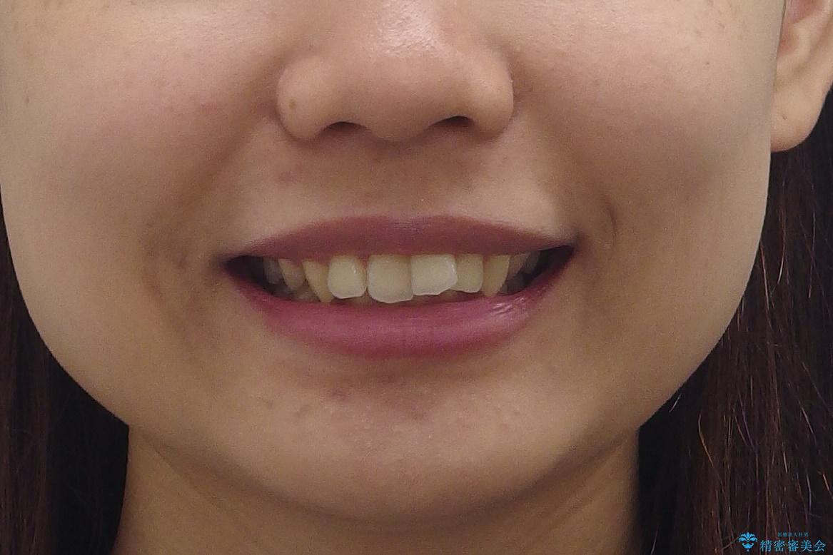 深いかみ合わせ 出っ歯の治療 インビザラインでの治療前(顔貌)