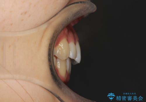 重度のガタガタ ハーフリンガルによる目立たない抜歯矯正の治療後