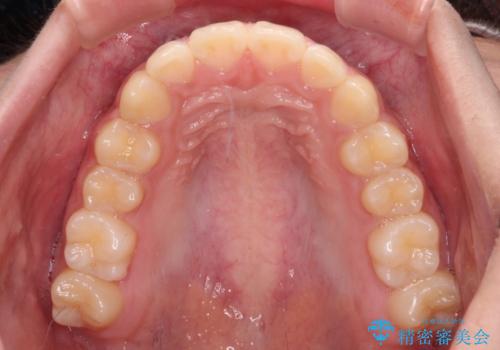 下の前歯が隠れてしまうほど深い咬み合わせ 高校生のインビザライン矯正治療の治療後