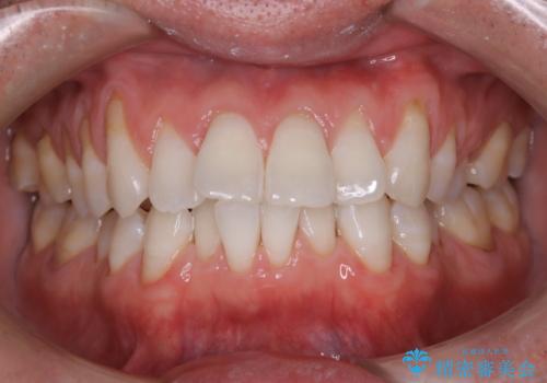 30代男性 PMTCで歯石取りの治療後