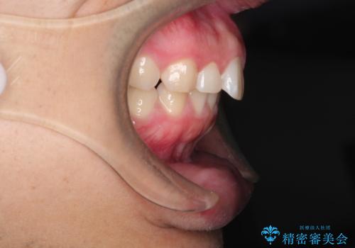 出っ歯が気になる インビザラインによる出っ歯の目立たない矯正の治療前