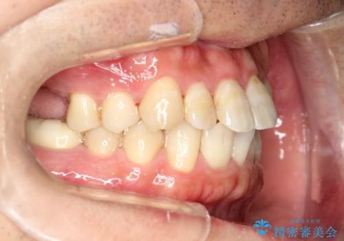 インビザライン矯正治療とインプラント治療 同時並行での全体治療の症例 治療前