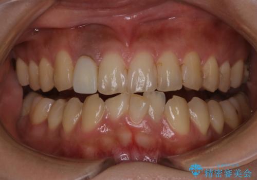 前歯のセラミック作成前にオフィスホワイトニングの症例 治療前