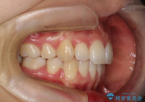重度のガタガタ　ハーフリンガルによる目立たない抜歯矯正の治療後