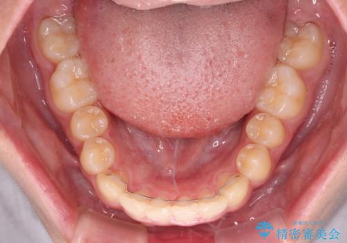 下の前歯が隠れてしまうほど深い咬み合わせ 高校生のインビザライン矯正治療の治療後