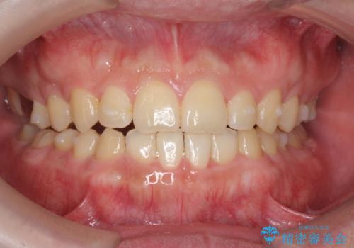 インビザラインで行うカモフラージュ矯正の治療中