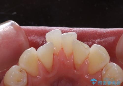 30代男性 PMTCで歯石取りの治療後