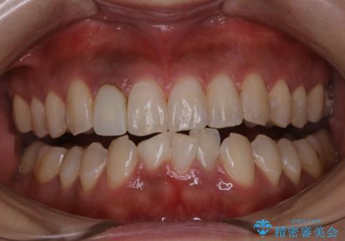 前歯のセラミック作成前にオフィスホワイトニングの治療後