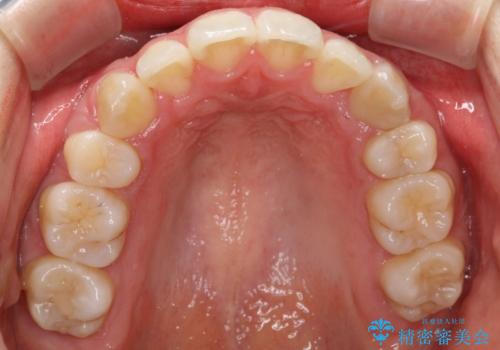 重度のガタガタ ハーフリンガルによる目立たない抜歯矯正の治療後