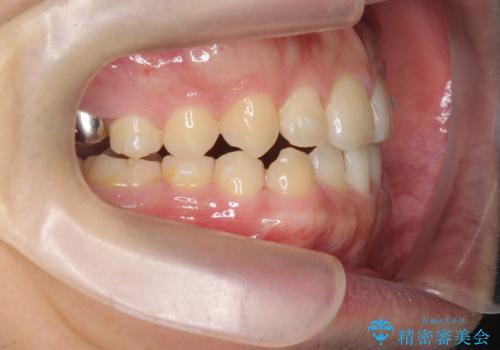 インビザラインで行うカモフラージュ矯正の治療中