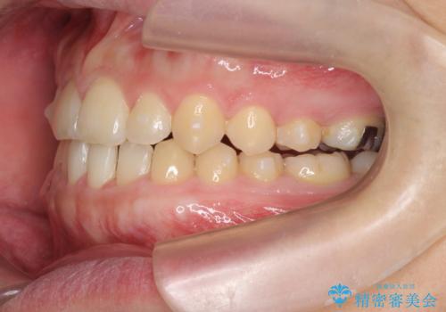 インビザラインで行うカモフラージュ矯正の治療中
