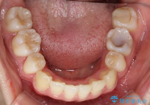重度のガタガタ ハーフリンガルによる目立たない抜歯矯正の治療後