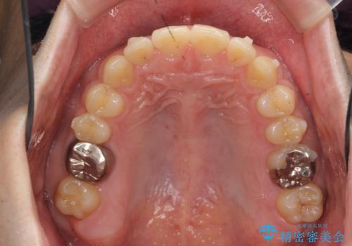 インビザラインで行うカモフラージュ矯正の治療中
