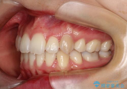 重度のガタガタ　ハーフリンガルによる目立たない抜歯矯正の治療後