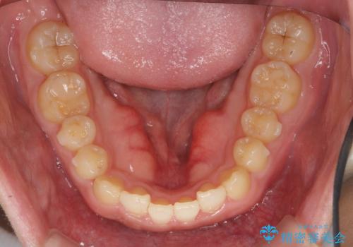 インビザラインで行うカモフラージュ矯正の治療中
