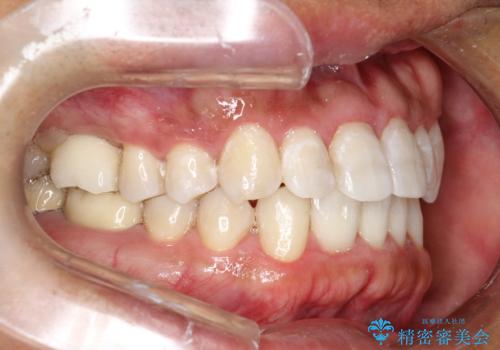 インビザライン矯正治療とインプラント治療 同時並行での全体治療の症例 治療後