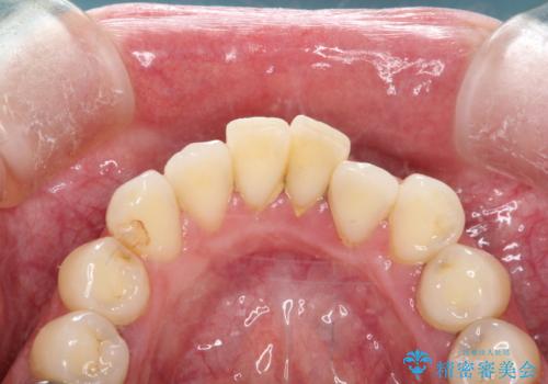 歯周病治療　歯科衛生士による歯石除去の治療前