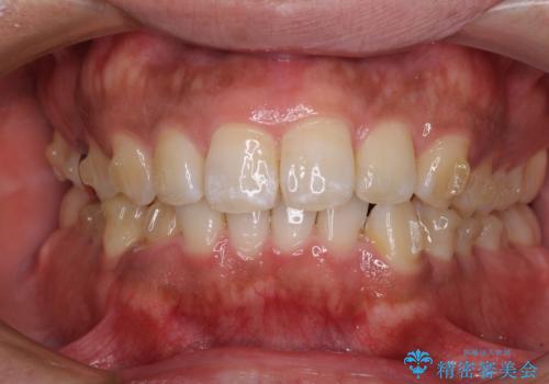 インビザラインによる矯正治療と、折れてしまった歯のインプラント補綴治療の治療中