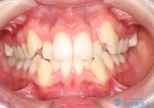 重度のガタガタ ハーフリンガルによる目立たない抜歯矯正