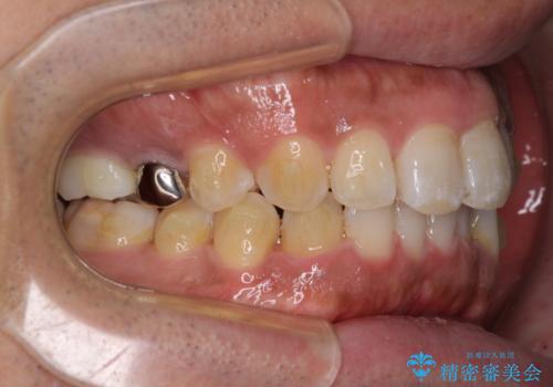 インビザラインによる矯正治療と、折れてしまった歯のインプラント補綴治療の治療中