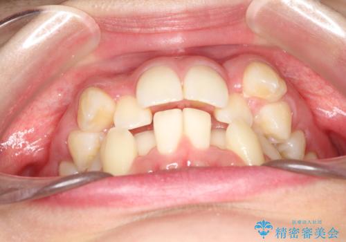 重度のガタガタ ハーフリンガルによる目立たない抜歯矯正の治療前