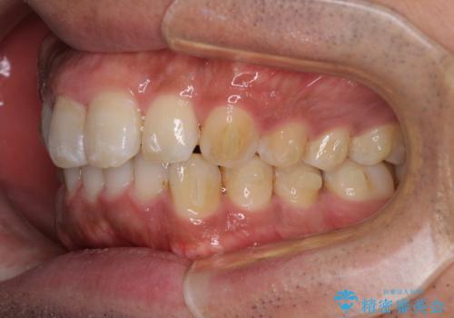 インビザラインによる矯正治療と、折れてしまった歯のインプラント補綴治療の治療中