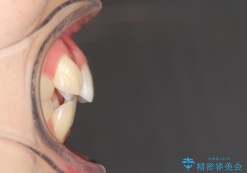 重度のガタガタ　ハーフリンガルによる目立たない抜歯矯正の治療前