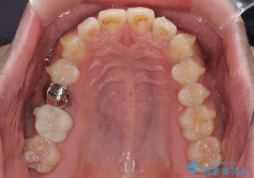 インビザラインによる矯正治療と、折れてしまった歯のインプラント補綴治療の治療中