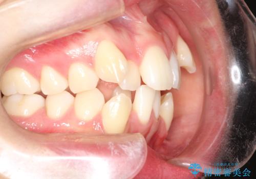 重度のガタガタ ハーフリンガルによる目立たない抜歯矯正の治療前