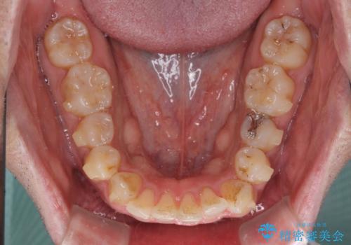 インビザラインによる矯正治療と、折れてしまった歯のインプラント補綴治療の治療中