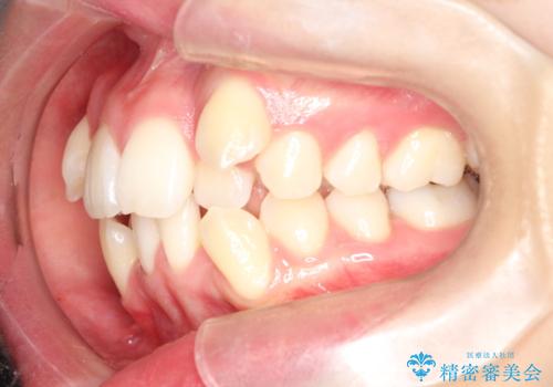 重度のガタガタ ハーフリンガルによる目立たない抜歯矯正の治療前