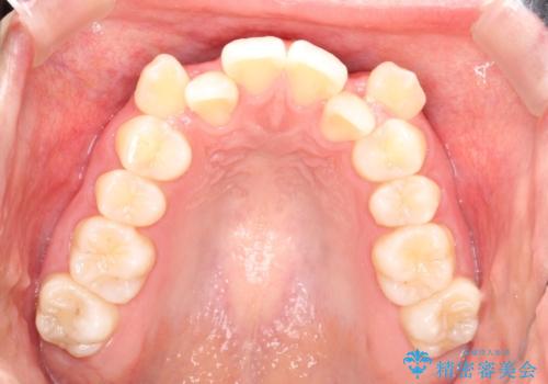 重度のガタガタ ハーフリンガルによる目立たない抜歯矯正の治療前