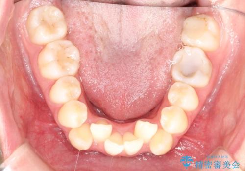 重度のガタガタ ハーフリンガルによる目立たない抜歯矯正の治療前