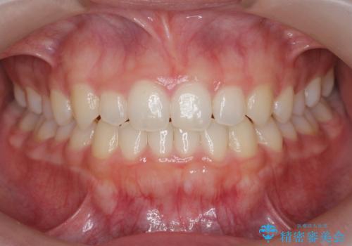 前歯のガタつき・ねじれを治すマウスピース矯正の症例 治療後