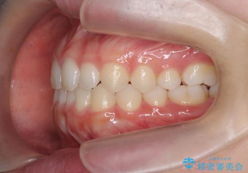 前歯のガタつき・ねじれを治すマウスピース矯正の治療後