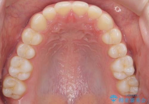前歯のガタつき・ねじれを治すマウスピース矯正の治療後