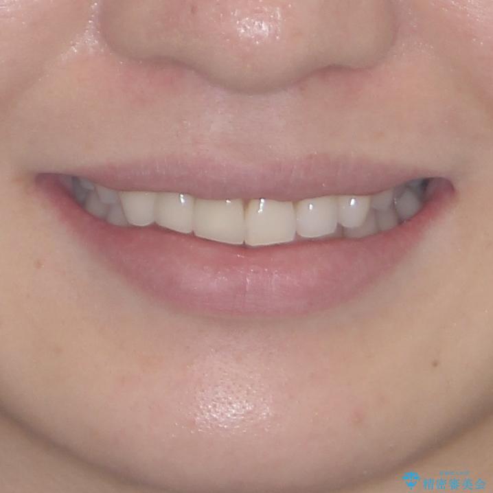 一度諦めた矯正にチャレンジしたい インビザラインとセラミック治療の治療後(顔貌)